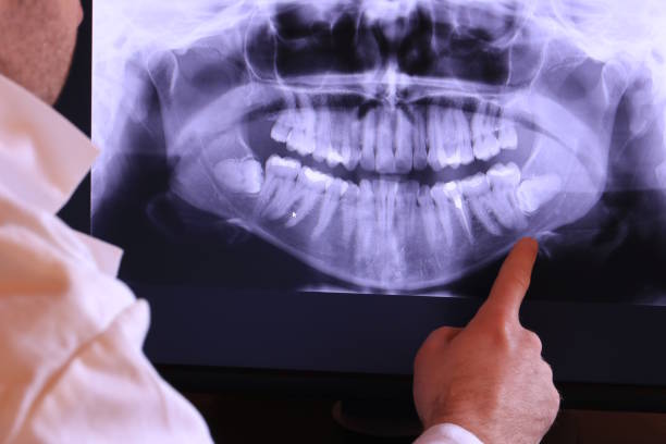 Best Emergency Wisdom Teeth Removal in Yorktown, IN